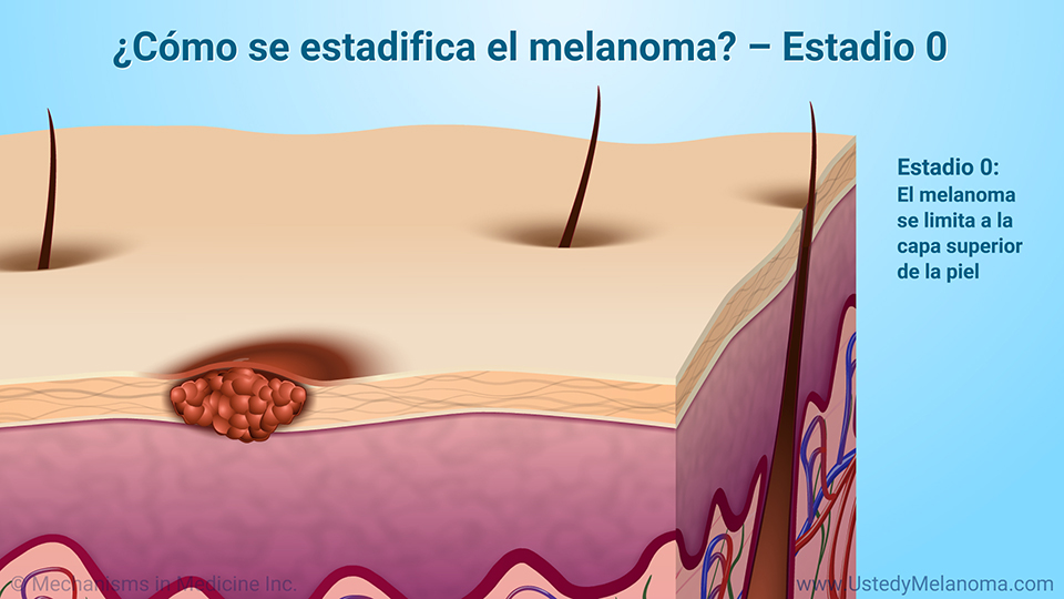 ¿Cómo se estadifica el melanoma? - Estadio 0
