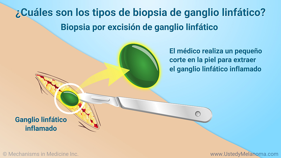 ¿Cuáles son los tipos de biopsia de ganglio linfático?