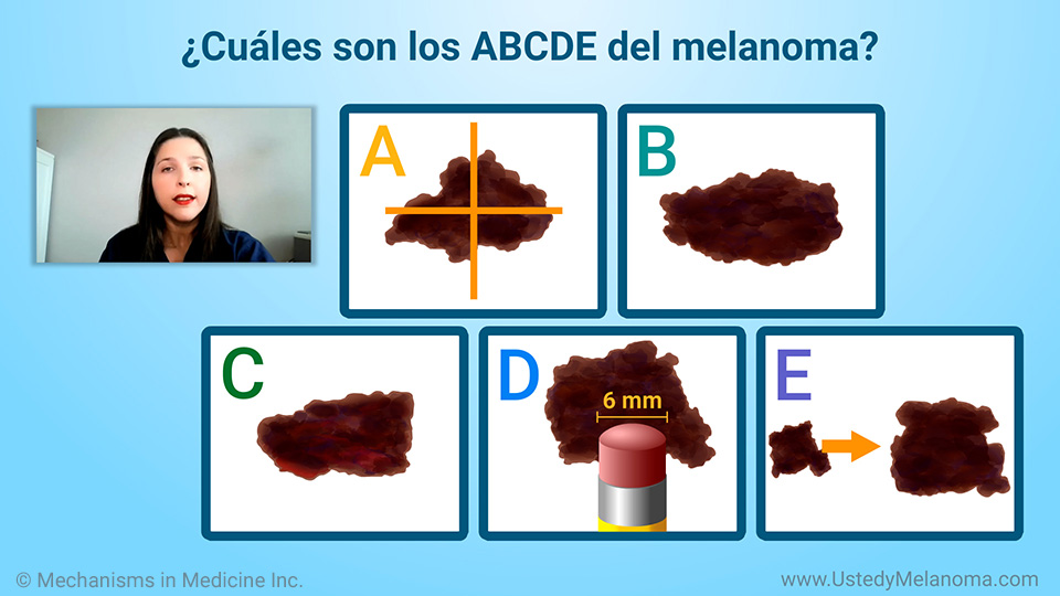 ¿Cuáles son los signos y síntomas del melanoma?