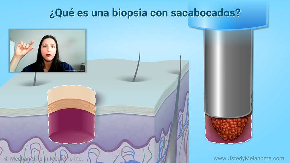 ¿Qué tipo de biopsias se utilizan para el melanoma?