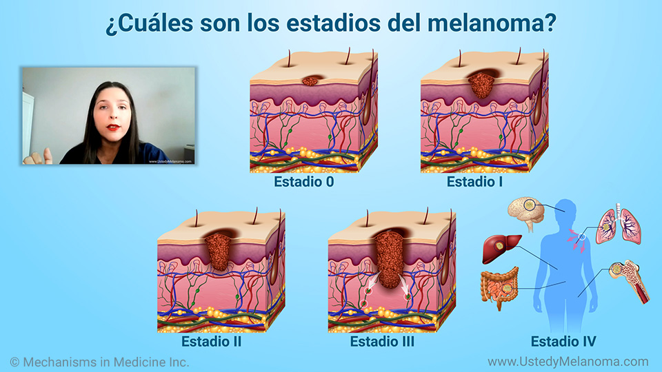 ¿Cuáles son los estadios del melanoma?