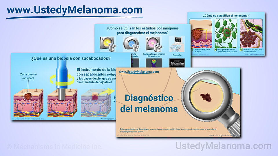 Presentación de diapositivas - Diagnóstico del melanoma