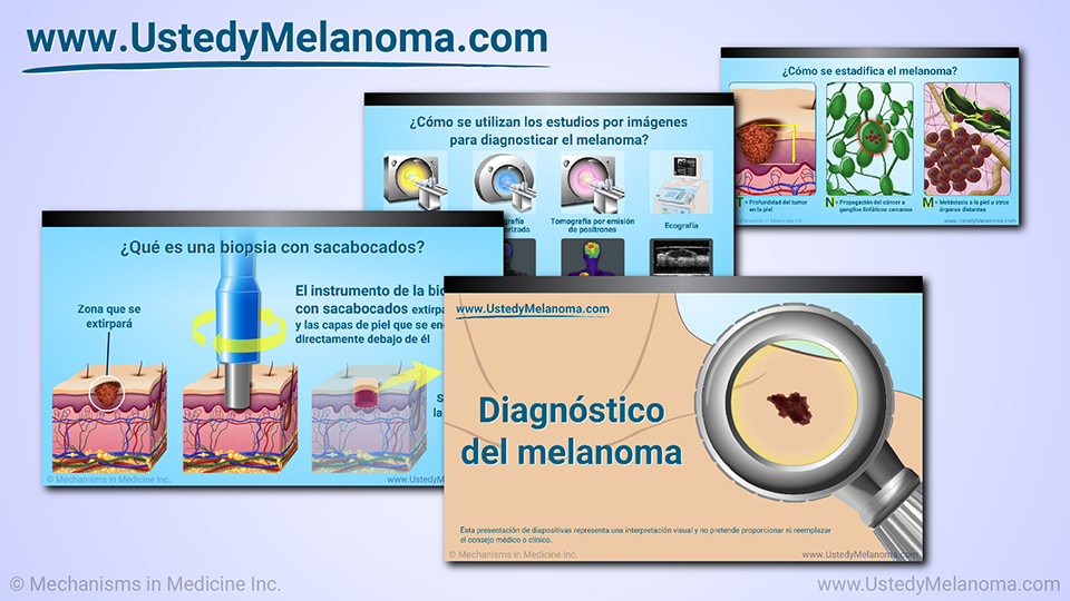 Presentación de diapositivas - Diagnóstico del melanoma