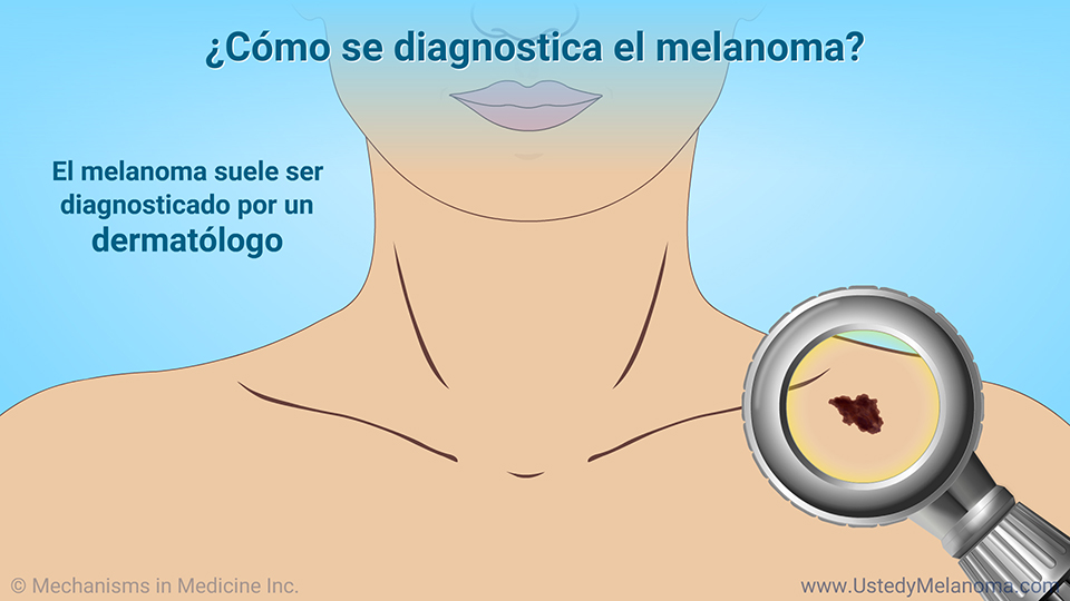 ¿Cómo se diagnostica el melanoma?