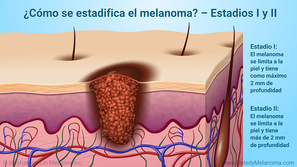 ¿Cómo se estadifica el melanoma? - Estadios I y II