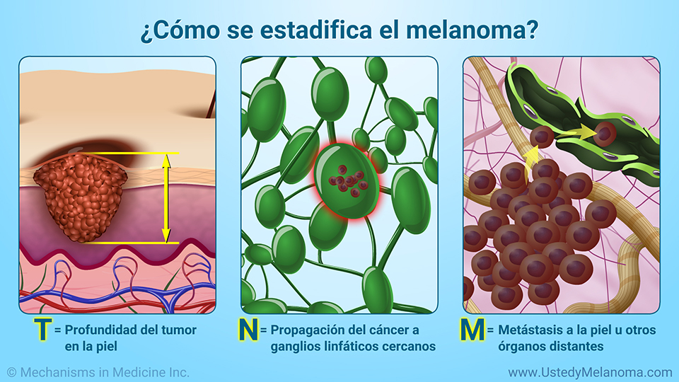 ¿Cómo se estadifica el melanoma? - TNM