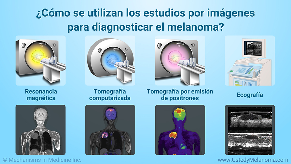 ¿Cómo se utilizan los estudios por imágenes para diagnosticar el melanoma?