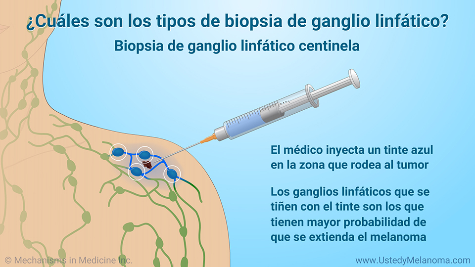 ¿Cuáles son los tipos de biopsia de ganglio linfático?
