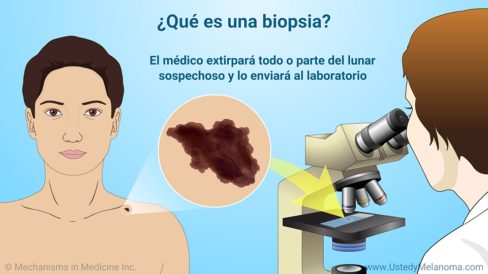 ¿Qué es una biopsia?