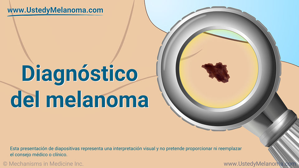 Diagnóstico del melanoma
